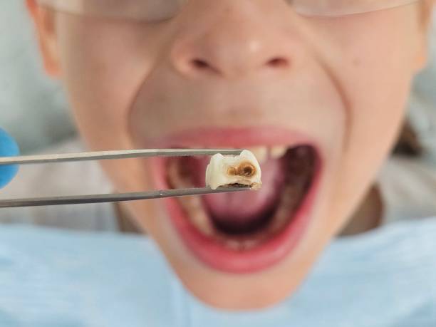 Best Emergency Root Canal Treatment in Stone Park, IL